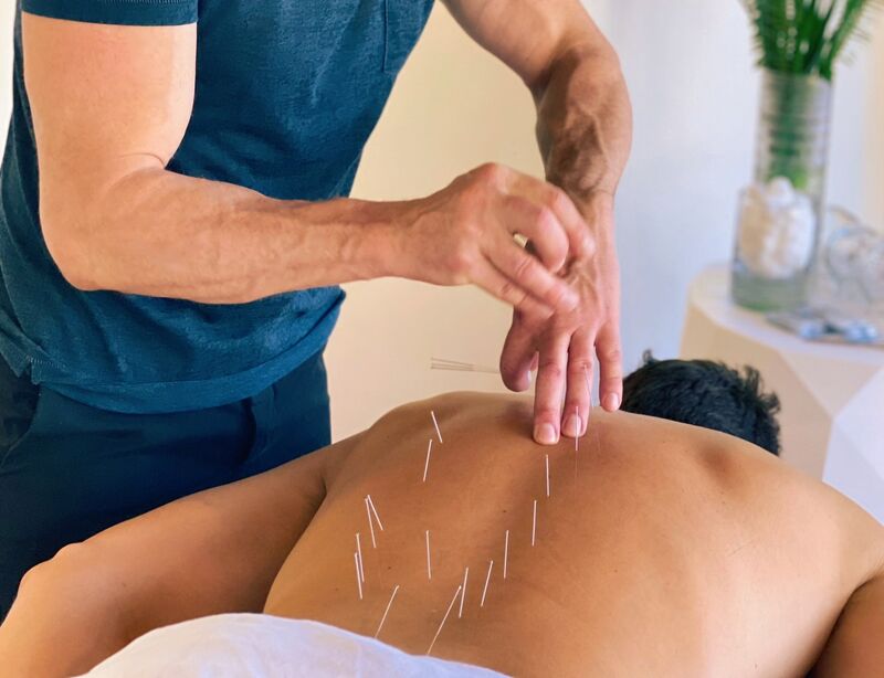Acupuncture needles placed along the upper back during a treatment